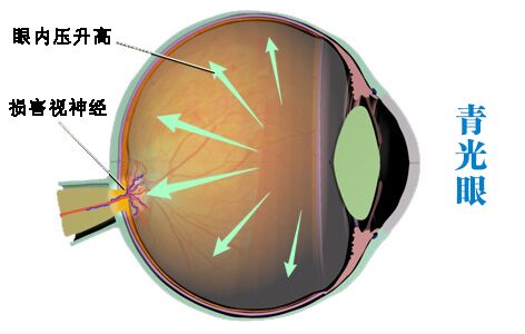 患青光眼为什么会致盲?